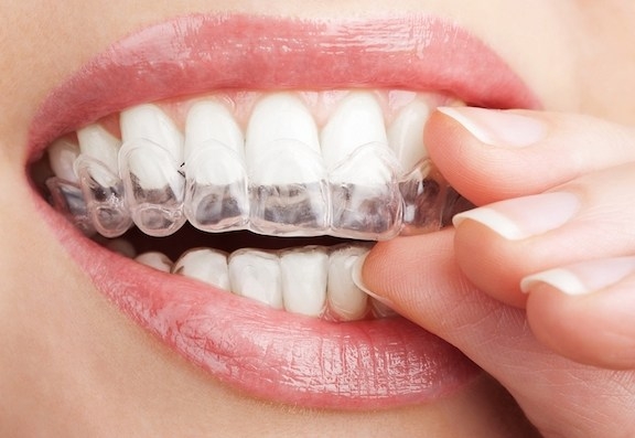 clear-aligner