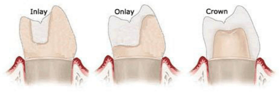 inlays-onlays