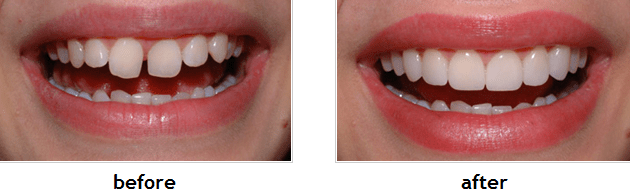 porcelain-veneers